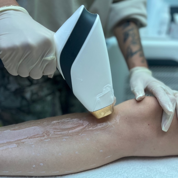 Persönliche Beratung zur Laser Haarentfernung